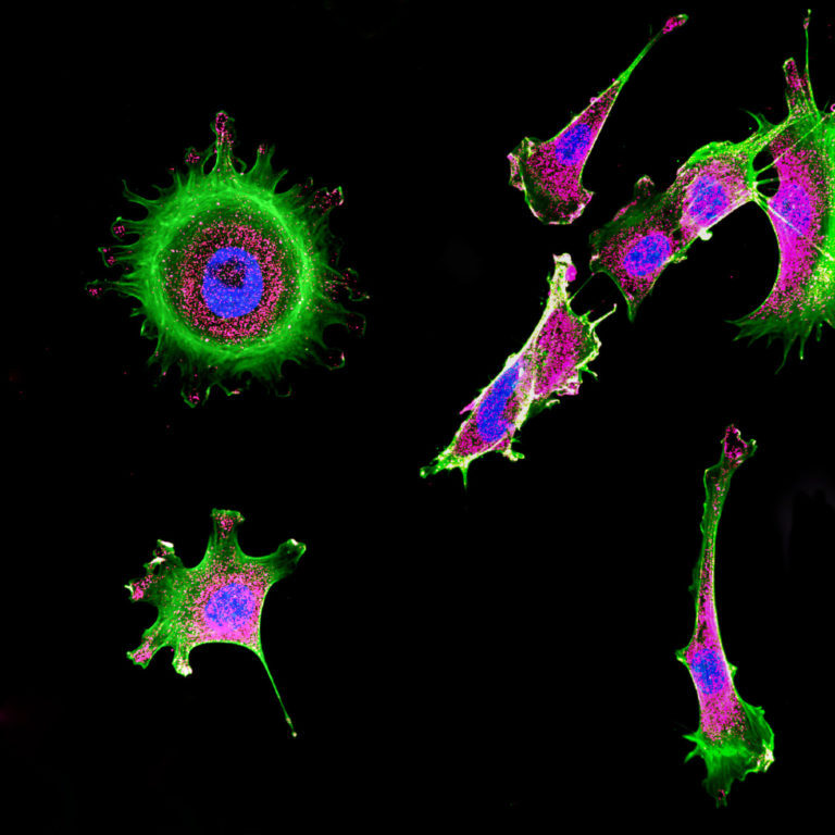 Immunofluorescence of multiple tumor cells grown in tissue culture for cancer research and visualized via confocal microscopy